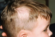 Saçkıran Hastalığında Sarımsak Tedavisi